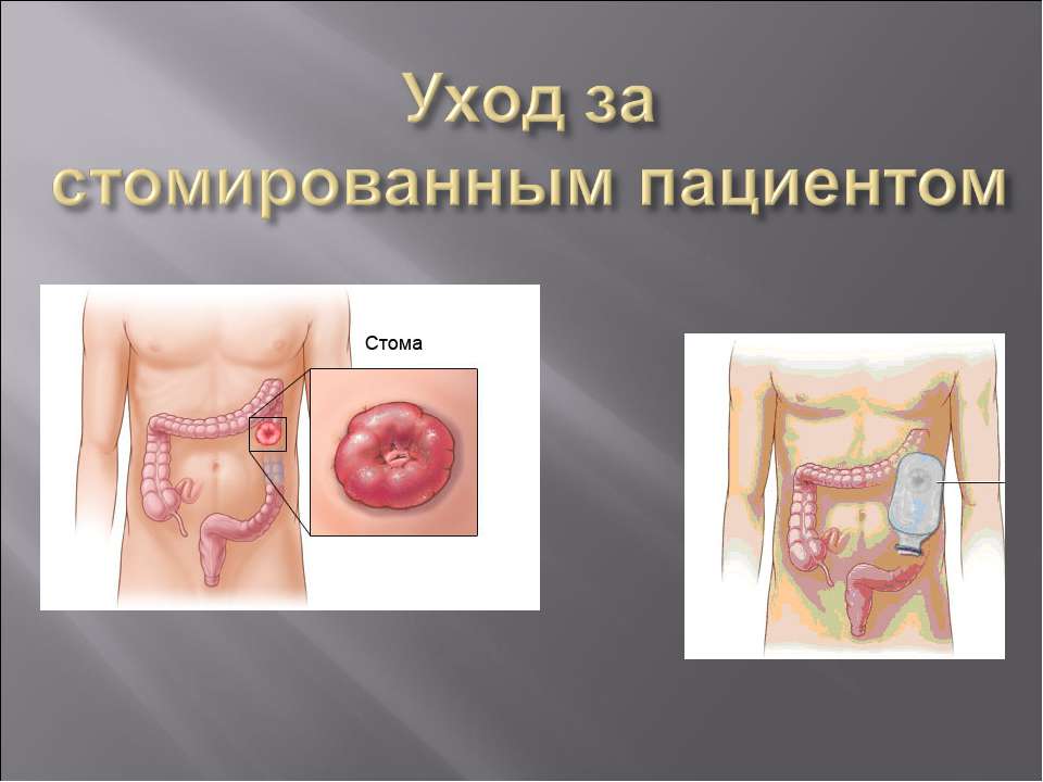 Уход за стомированным пациентом - Скачать Читать Лучшую Школьную Библиотеку Учебников